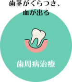 歯周病治療 歯茎がぐらつき、血が出る